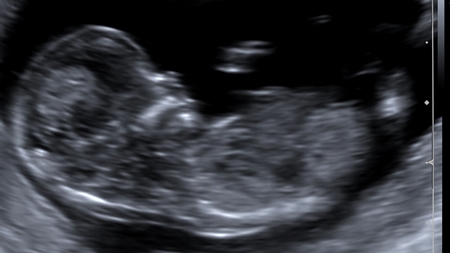 妊娠12週エコー写真