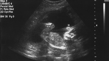妊娠14週エコー　超音波　写真
