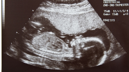妊娠15週エコー　超音波　写真