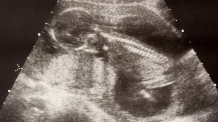 妊娠16週エコー　超音波　写真