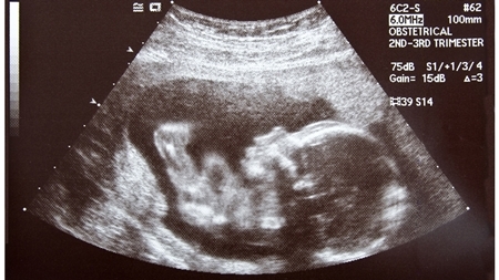 妊娠17週エコー　超音波　写真