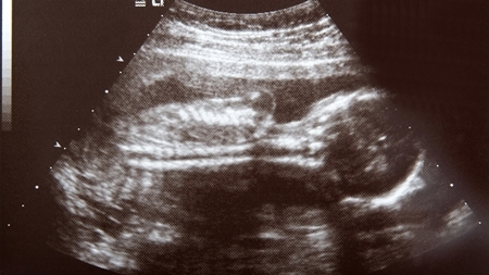 妊娠17週エコー　超音波　写真 02