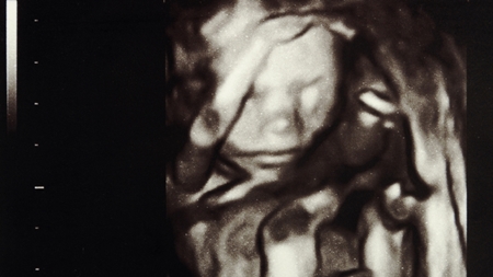 妊娠18週エコー　4D超音波　写真