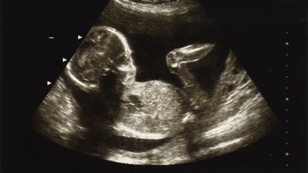 妊娠20週エコー　超音波　写真