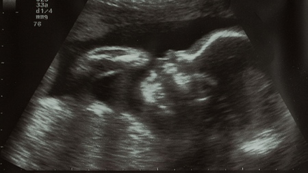 妊娠24週エコー　超音波　写真