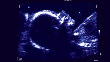 妊娠26週　胎児エコー　超音波　写真