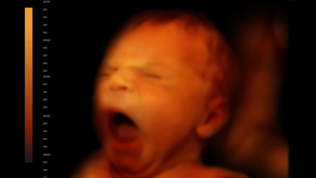 胎児　エコー　3D超音波　写真
