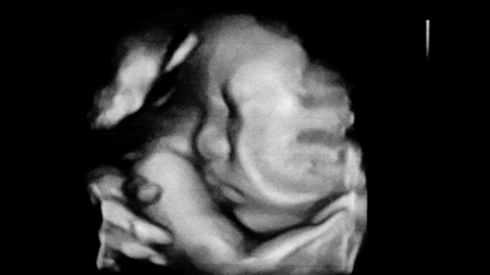 妊娠35週　胎児　エコー　3D超音波　写真