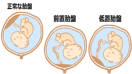 正常な胎盤と前置胎盤、低置胎盤の比較表