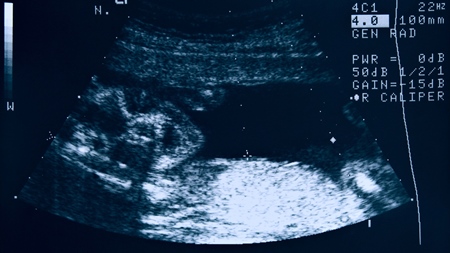妊娠22週エコー　超音波　写真