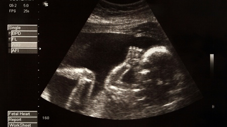 妊娠23週エコー　超音波　写真