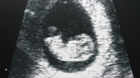 妊娠10週　エコー画像