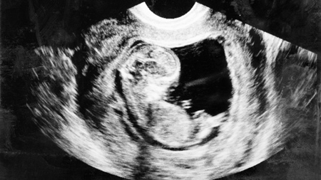 妊娠３ヶ月のエコー写真
