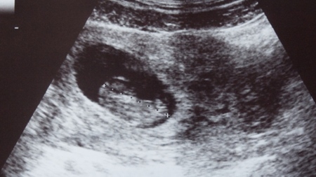 妊娠３ヶ月胎児エコー　超音波　写真