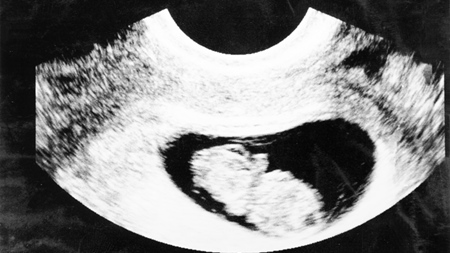 妊娠9週　胎児　エコー　超音波　写真