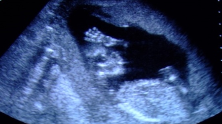 妊娠4ヶ月　胎児エコー　超音波　写真