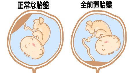 正常な胎盤と前置胎盤