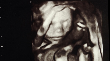 妊娠5ヶ月　18週　胎児　エコー
