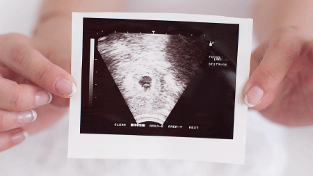 産婦人科受診のタイミングと胎嚢確認