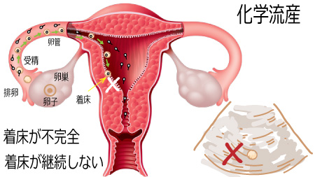 妊娠検査薬反応後の化学流産