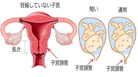 子宮頸管長検査を受け始める時期