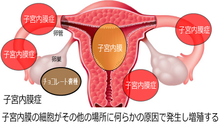 子宮または卵管の異常2
