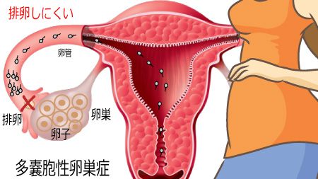 多嚢胞性卵巣症