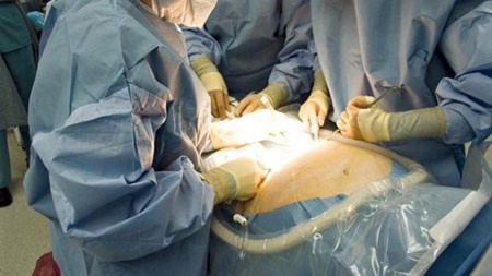 前置胎盤の帝王切開手術