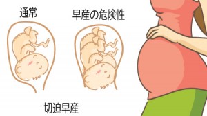切迫早産について知っておきたいこと | ニンアカ