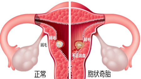 妊娠初期出血には要注意2